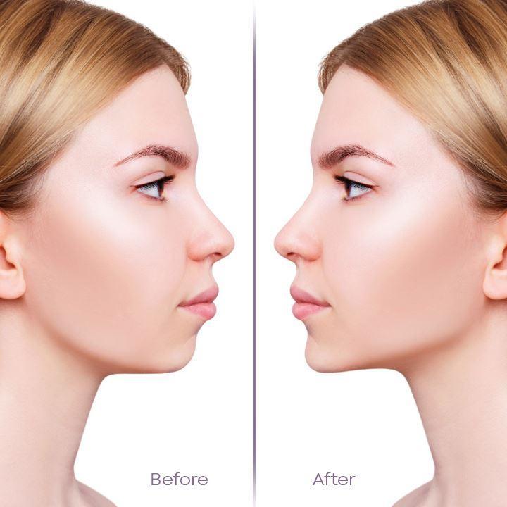 Visage | Unsichtbare Gesichtslifter Tape für straffere Haut